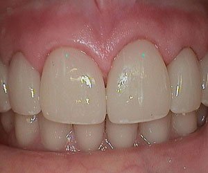 ceramic-restorations-lab-denver-co https://american-dental-arts.com/wp-content/uploads/2024/03/ceramic-restorations-lab-denver-co.jpg