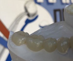 full-contour-zirconia-crowns-and-bridges-denver https://american-dental-arts.com/wp-content/uploads/2024/03/full-contour-zirconia-crowns-and-bridges-denver.jpg
