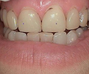 ips-empress-ceramic-restorations-denver https://american-dental-arts.com/wp-content/uploads/2024/03/ips-empress-ceramic-restorations-denver.jpg