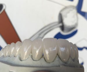 https://american-dental-arts.com/wp-content/uploads/2024/03/porcelain-fused-to-zirconia-denver-co.jpg