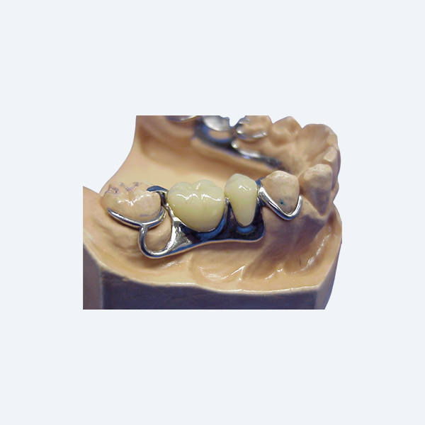 https://american-dental-arts.com/wp-content/uploads/2025/08/Cast-partial-denture.webp