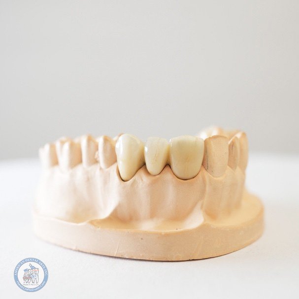 https://american-dental-arts.com/wp-content/uploads/2025/08/Zirconia.jpg